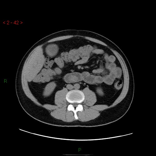File:Ampullary carcinoma (Radiopaedia 56396-63056 Axial non-contrast 28).jpg