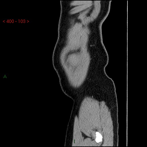 Ampullary carcinoma (Radiopaedia 56396-63056 D 102).jpg