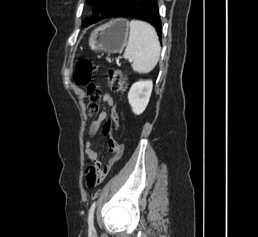 File:Ampullary tumor (Radiopaedia 60333-67998 C 50).jpg