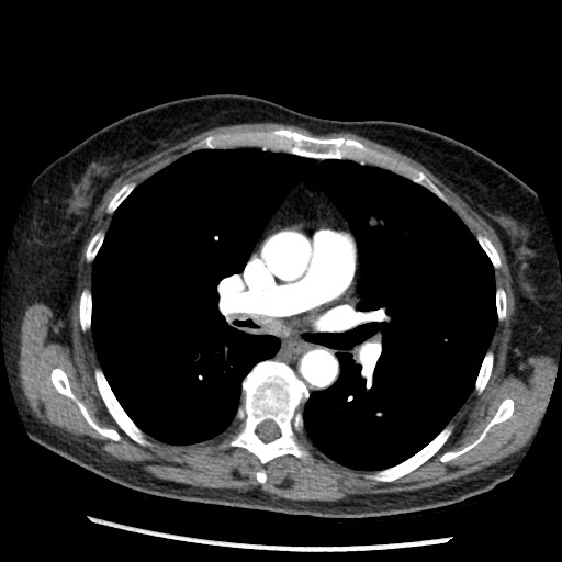 Amyloidosis - bronchial and diffuse nodular pulmonary involvement (Radiopaedia 60156-67745 A 24).jpg