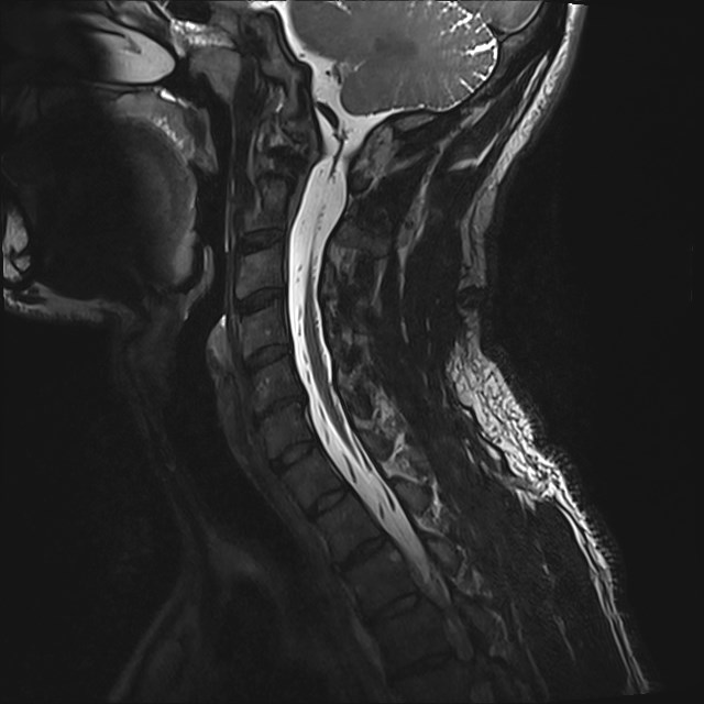 Amyotrophic lateral sclerosis (Radiopaedia 87352-103658 I 40).jpg