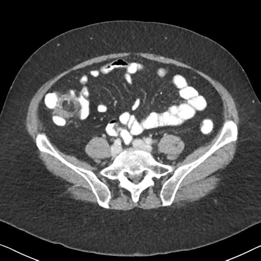 Anal adenocarcinoma - tumor regression grade 1 (Radiopaedia 31358-32103 Axial POST 50).jpg