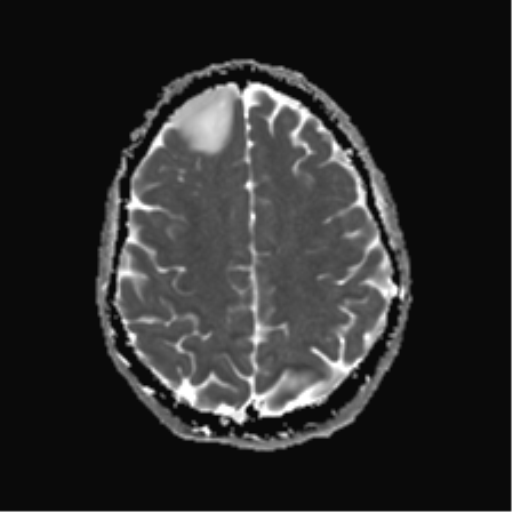 File:Anaplastic astrocytoma IDH mutant (Radiopaedia 50046-55341 Axial ADC 21).png