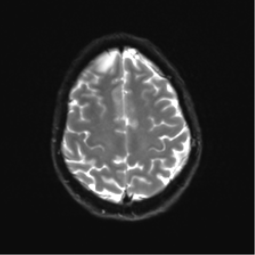 Anaplastic astrocytoma IDH mutant (Radiopaedia 50046-55341 Axial DWI 22).png