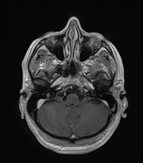 Anaplastic astrocytoma IDH wild-type (Radiopaedia 49984-55273 Axial T1 C+ 14).png
