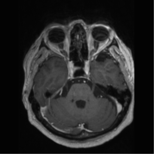 File:Anaplastic astrocytoma IDH wild-type (pseudoprogression) (Radiopaedia 42209-45277 Axial T1 C+ 35).png