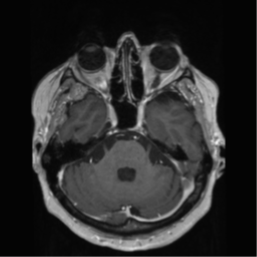 File:Anaplastic astrocytoma IDH wild-type (pseudoprogression) (Radiopaedia 42209-45278 Axial T1 C+ 53).png