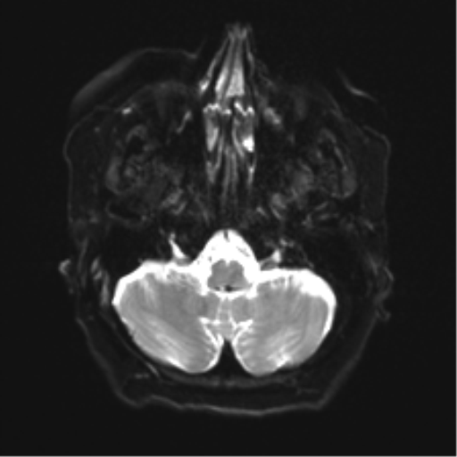 Anaplastic astrocytoma IDH wild-type (pseudoprogression) (Radiopaedia 42209-45279 Axial DWI 5).png