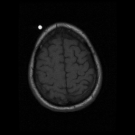 File:Anaplastic meningioma with recurrence (Radiopaedia 34452-35783 Axial T1 18).png