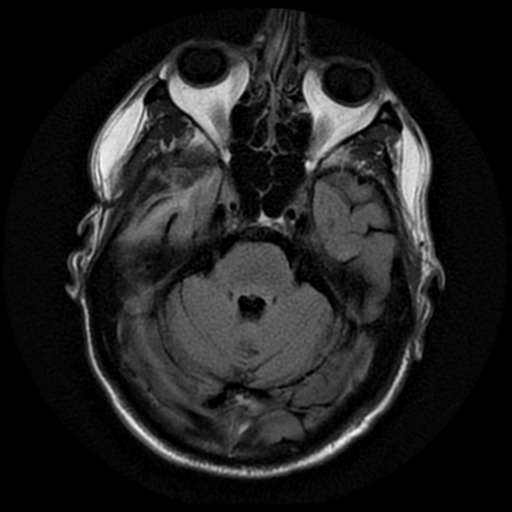 File:Anaplastic meningioma with recurrence (Radiopaedia 34452-35790 Axial T2 FLAIR 6).png