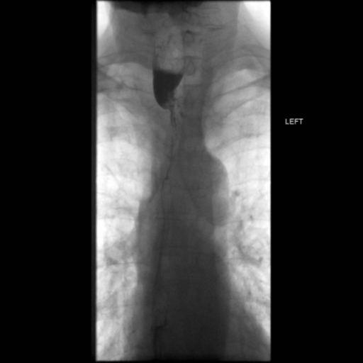 File:Anastomotic stricture post Ivor Lewis esophagectomy (Radiopaedia 47937-52715 Frontal 37).png