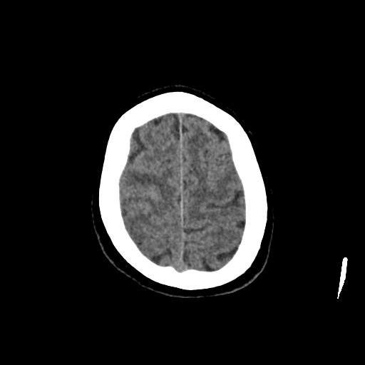Aneursym related subarachnoid hemorrhage with hydrocephalus (Radiopaedia 45105-49083 Axial non-contrast 43).jpg