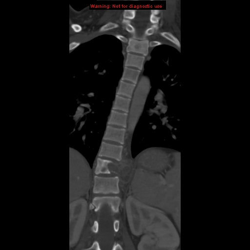 File:Aneurysmal bone cyst (Radiopaedia 9419-10102 Coronal bone window 8).jpg
