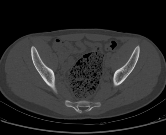 File:Aneurysmal bone cyst of ischium (Radiopaedia 25957-26094 Axial bone window 37).png