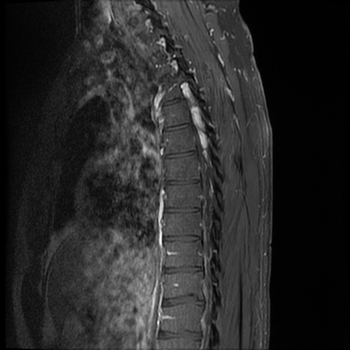 File:Angiolipoma - thoracic spine (Radiopaedia 28242-28479 E 10).jpg