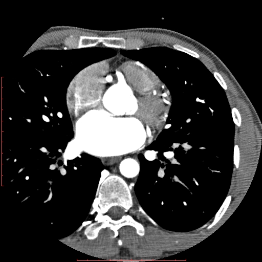 Anomalous left coronary artery from the pulmonary artery (ALCAPA) (Radiopaedia 70148-80181 A 137).jpg
