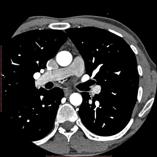 Anomalous left coronary artery from the pulmonary artery (ALCAPA) (Radiopaedia 70148-80181 A 3).jpg