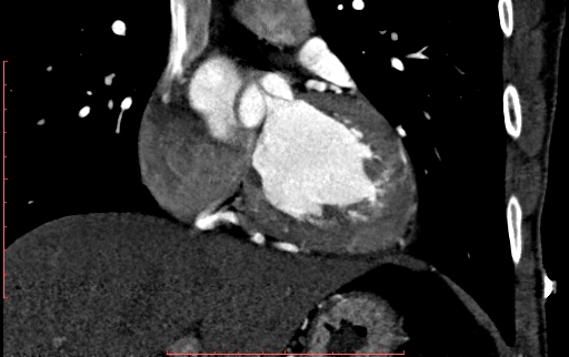 Anomalous left coronary artery from the pulmonary artery (ALCAPA) (Radiopaedia 70148-80181 B 150).jpg