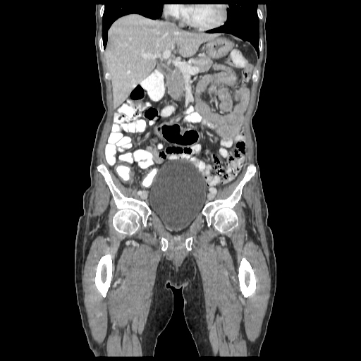 Anorectal carcinoma (Radiopaedia 44413-48064 B 26).jpg