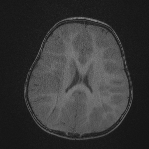 File:Anoxic brain injury (Radiopaedia 79165-92139 Axial MRA 164).jpg