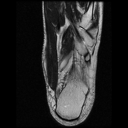 File:Anterior calcaneal process fracture (Radiopaedia 74654-85611 Axial T2 25).jpg