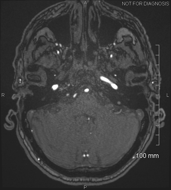 Anterior cerebral artery aneurysm (Radiopaedia 80683-94127 Axial MRA 46).jpg