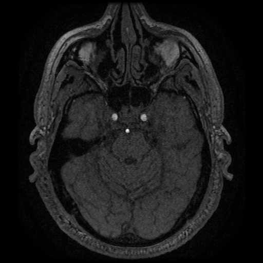 Anterior cerebral artery infarction (Radiopaedia 46794-51323 Axial MRA 45).jpg