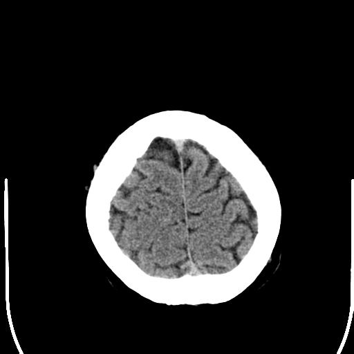 File:Anterior cerebral artery territory infarct (Radiopaedia 39327-41581 Axial non-contrast 26).png