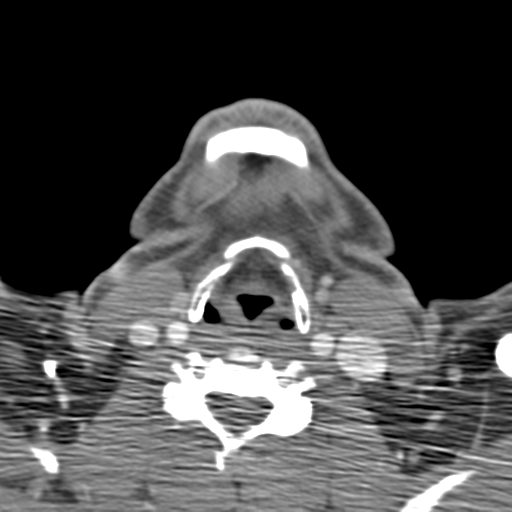 File:Anterior cerebral artery territory infarct (Radiopaedia 39327-41581 B 81).png