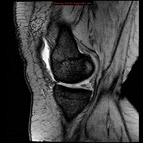 File:Anterior cruciate ligament tear (Radiopaedia 12329-12612 A 15).jpg