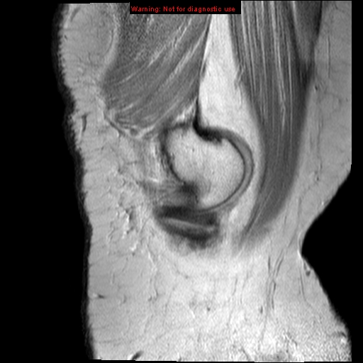 File:Anterior cruciate ligament tear (Radiopaedia 12329-12612 Sagittal T2 fat sat 19).jpg