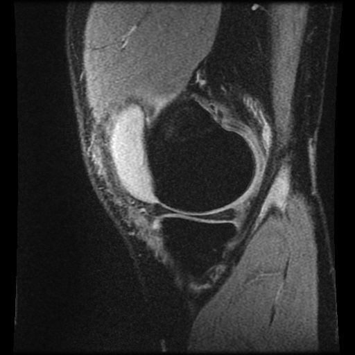 File:Anterior cruciate ligament tear (Radiopaedia 61500-69462 F 14).jpg