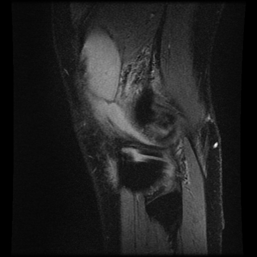Anterior cruciate ligament tear (Radiopaedia 61500-69462 F 82).jpg