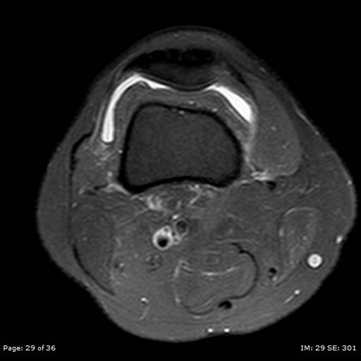 File:Anterior cruciate ligament tear (Radiopaedia 70783-80964 Axial PD fat sat 29).jpg