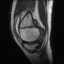 File:Anterior cruciate ligament tear - pediatric (Radiopaedia 62152-70260 Sagittal PD 44).jpg