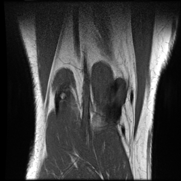 File:Anterior cruciate ligament tear with posteromedial corner injury, bucket-handle meniscal tear and chondral delamination (Radiopaedia 75501-86744 Coronal T1 23).jpg