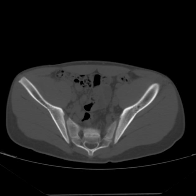 Anterior inferior iliac spine avulsion fracture (Radiopaedia 49469-54627 Axial bone window 20).jpg
