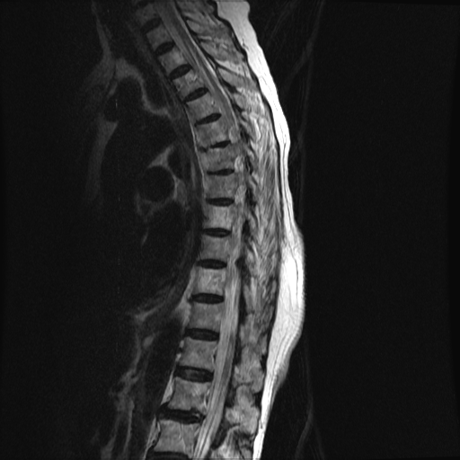 File:Anterior spinal artery syndrome (Radiopaedia 46335-50750 C 6).png