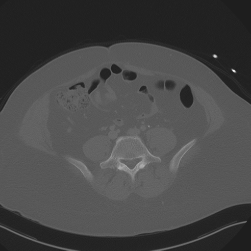 Anterior superior iliac spine avulsion fracture (Radiopaedia 44541-48244 Axial bone window 67).png