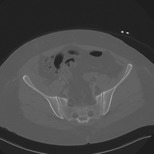 Anterior superior iliac spine avulsion fracture (Radiopaedia 44541-48244 Axial bone window 78).png
