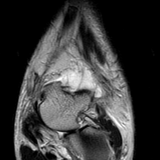 File:Anterior talofibular ligament rupture (Radiopaedia 15831-15484 Coronal T2 5).jpg
