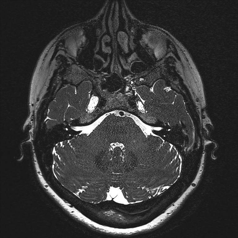 Anterior temporal encephalocele (Radiopaedia 82624-96808 Axial T2 high res 22).jpg