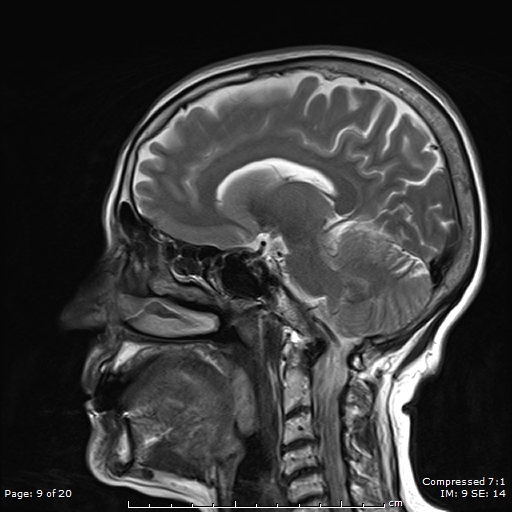 File:Anterior temporal lobe perivascular space (Radiopaedia 88283-104914 Sagittal T2 9).jpg