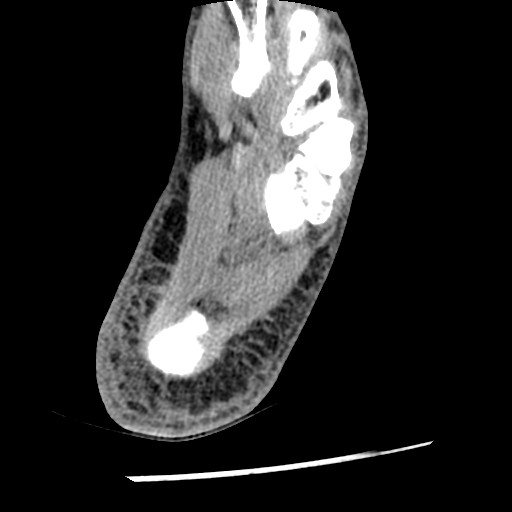 Anterior tibial artery false aneurysm (Radiopaedia 88984-105809 A 220).jpg