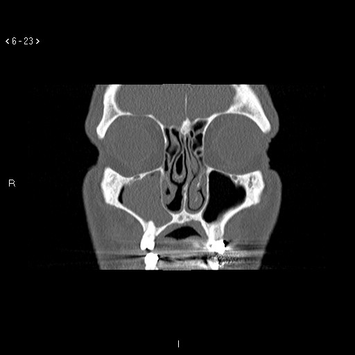 File:Antrochoanal Polyp (Radiopaedia 70510-80631 Coronal bone window 12).jpg