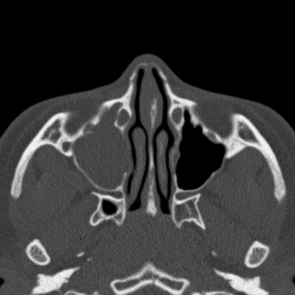 Antrochoanal polyp (Radiopaedia 33984-35202 Axial bone window 32).jpg