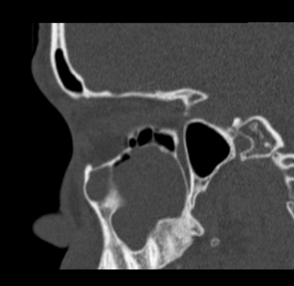 Antrochoanal polyp (Radiopaedia 33984-35202 Sagittal bone window 26).jpg