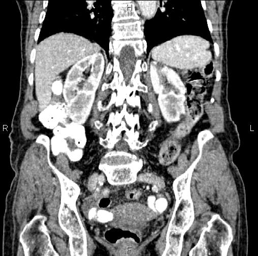 File:Aortic aneurysm and Lemmel syndrome (Radiopaedia 86499-102554 C 45).jpg