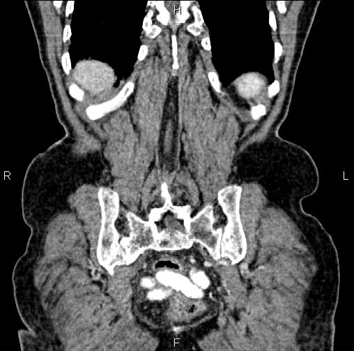 Aortic aneurysm and Lemmel syndrome (Radiopaedia 86499-102554 C 57).jpg