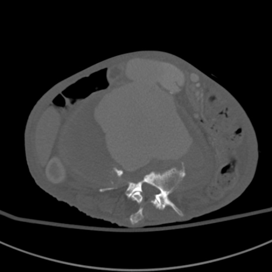 Aortic aneurysm with spinal destruction (Radiopaedia 42301-45410 Axial bone window 50).jpg